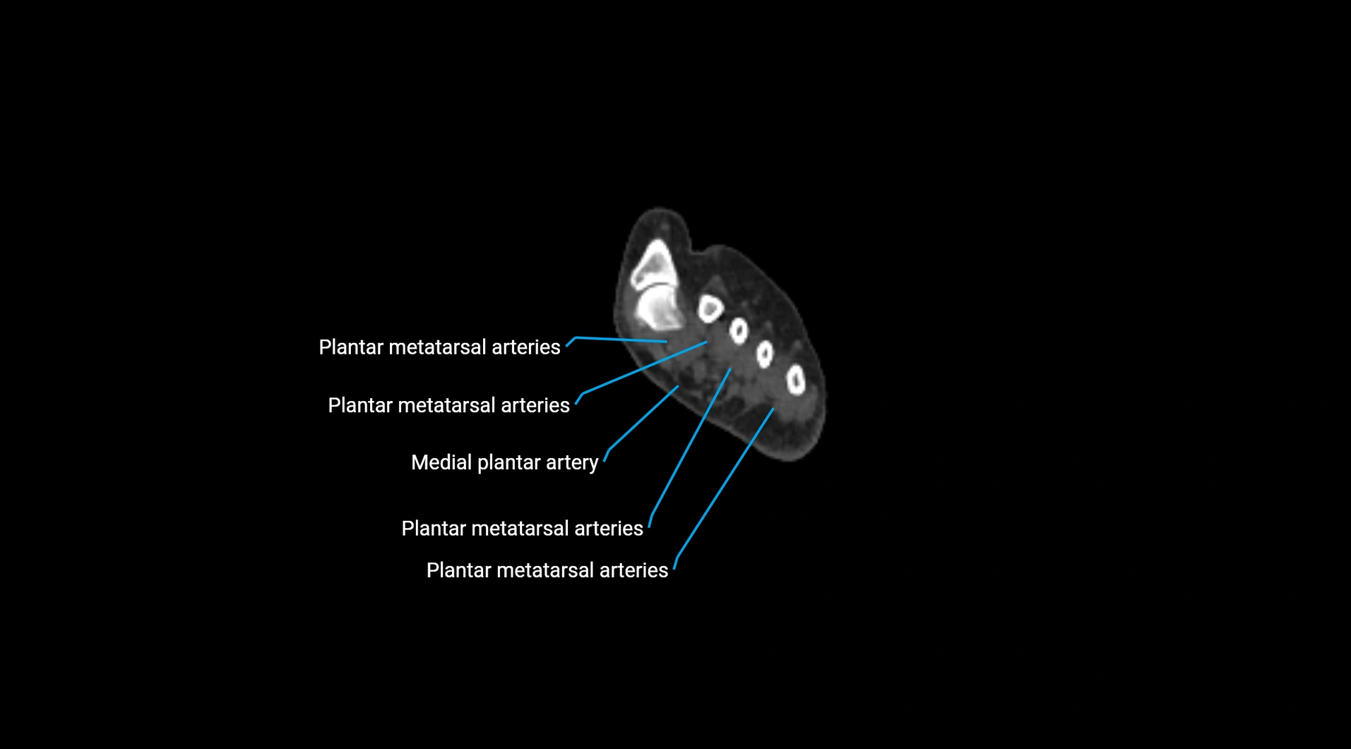 CTA lower limb cross sectional anatomy labelled image _302.webp